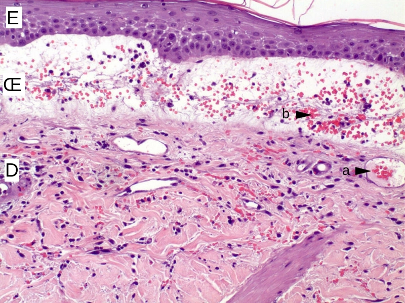 Biopsie biopsie purpura mollet agave oxalate